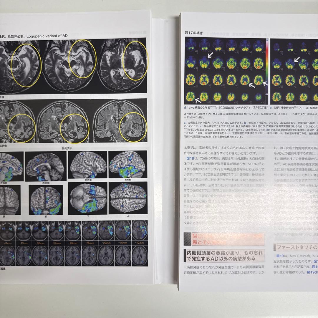 【裁断済】画像で究める認知症