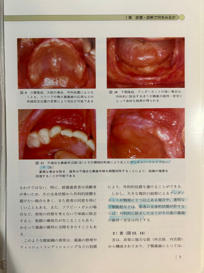 総義歯臨床の押さえどころ