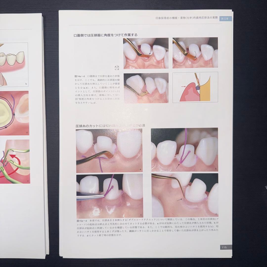 必ず上達 歯冠修復 下　裁断済み