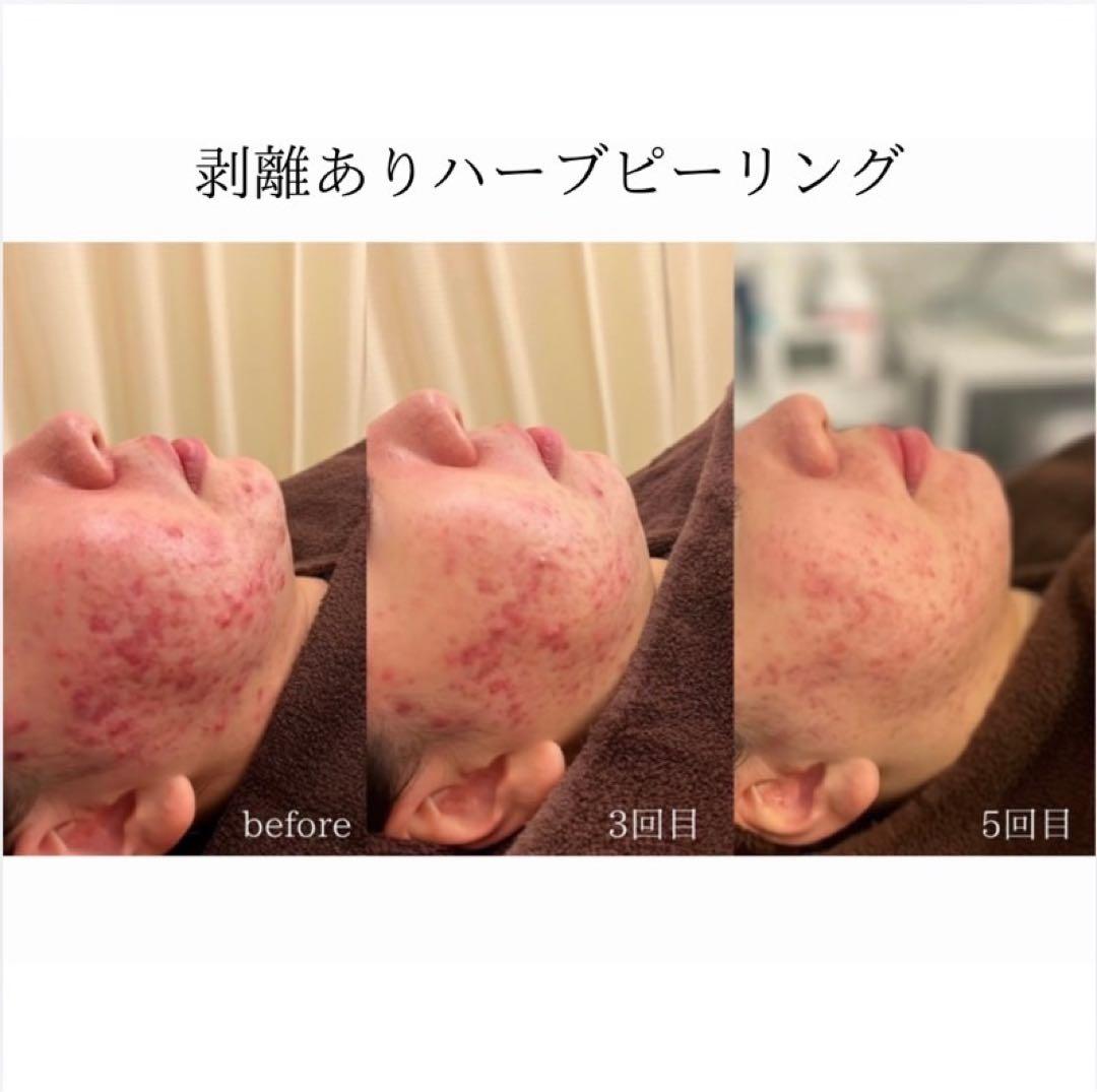 【JS♡】剥離ありハーブピーリング10回分