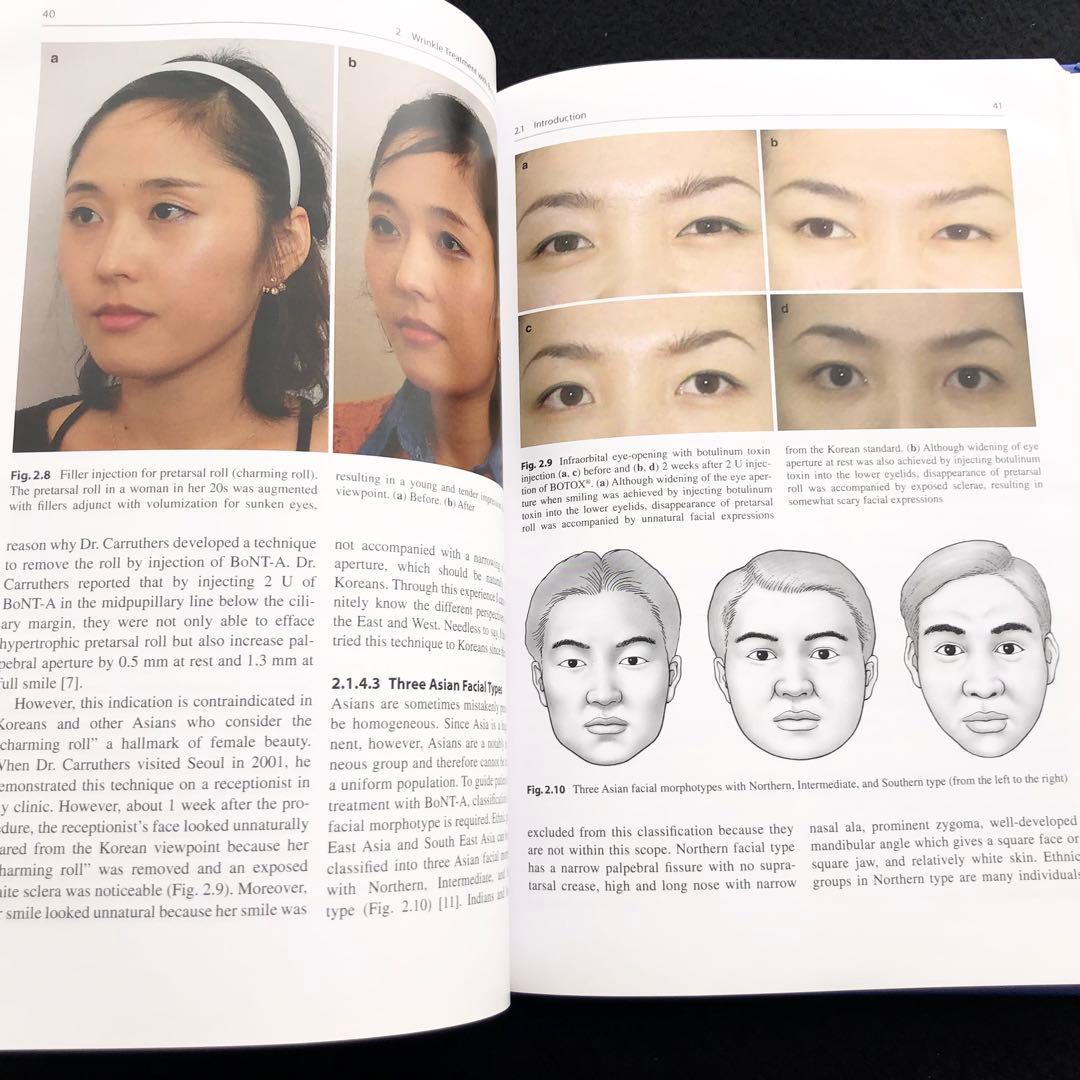 アジア人のためのボツリヌストキシン「Botulinum Toxin」