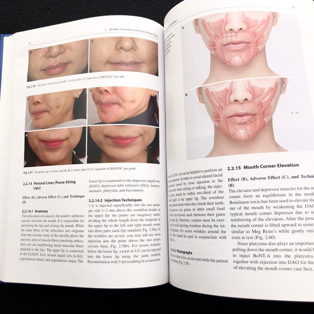 アジア人のためのボツリヌストキシン「Botulinum Toxin」