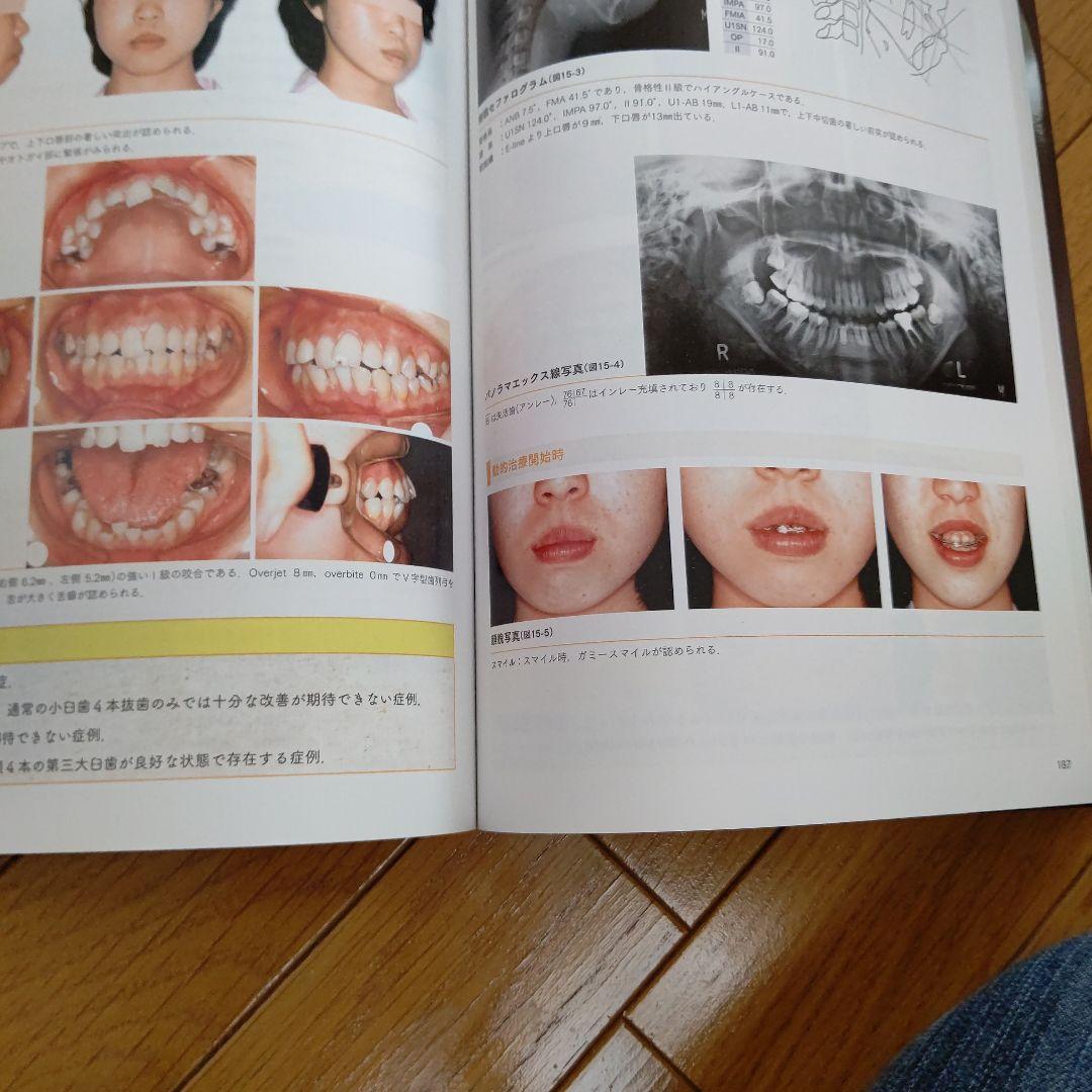 全顎矯正と部分矯正へのアプローチ : 非抜歯治療と抜歯治療の選択基準