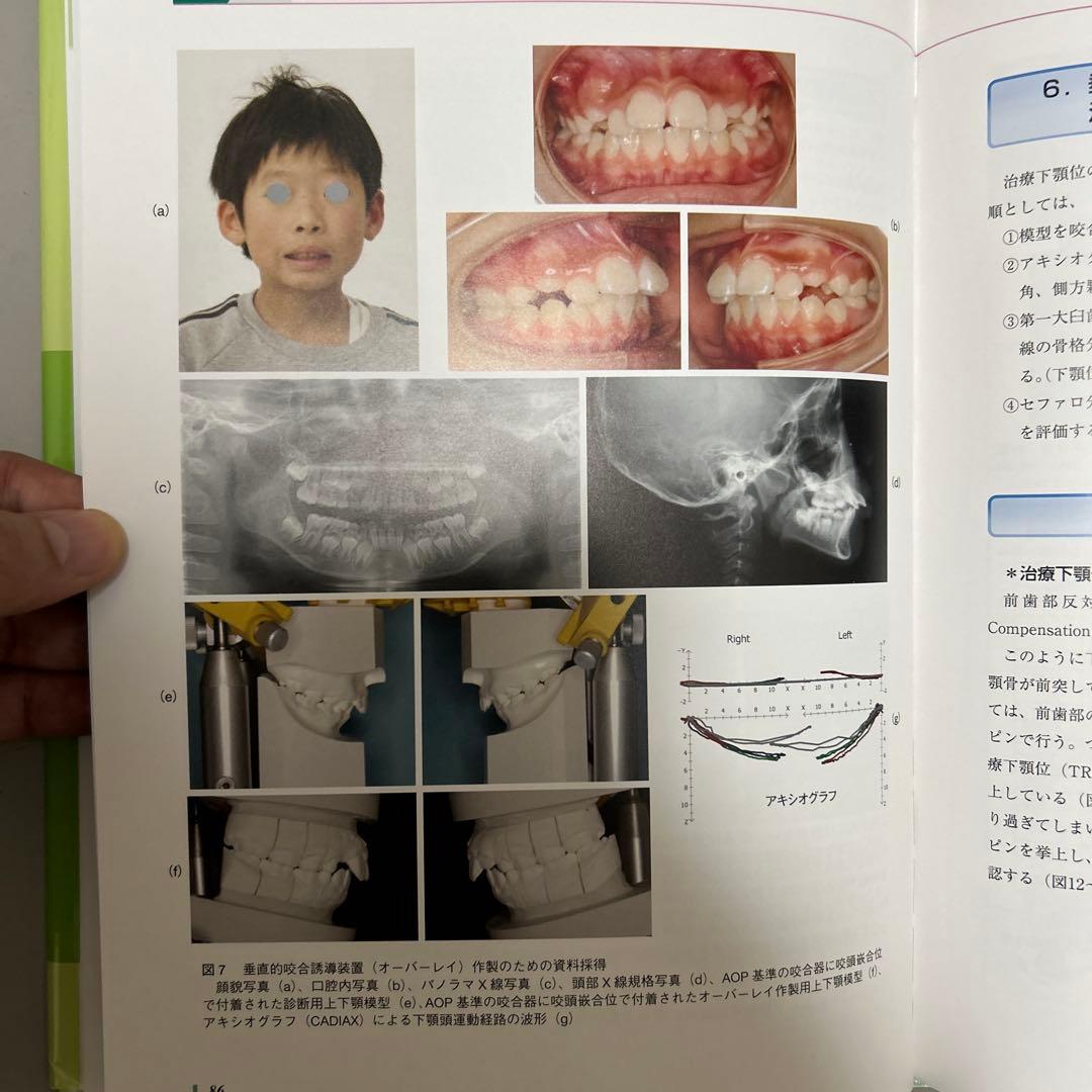 成長・発達期における不正咬合の早期治療
