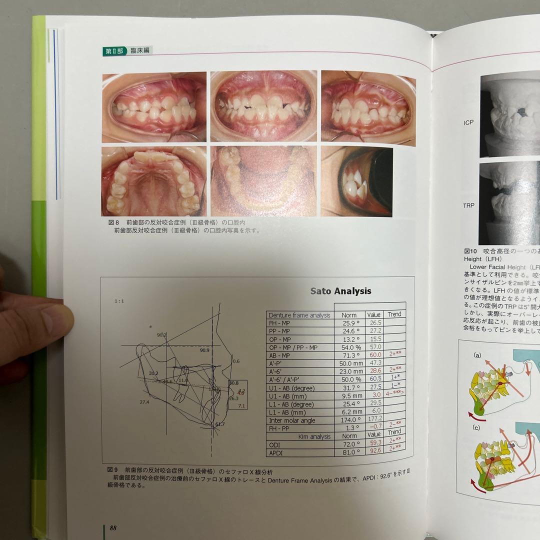 成長・発達期における不正咬合の早期治療