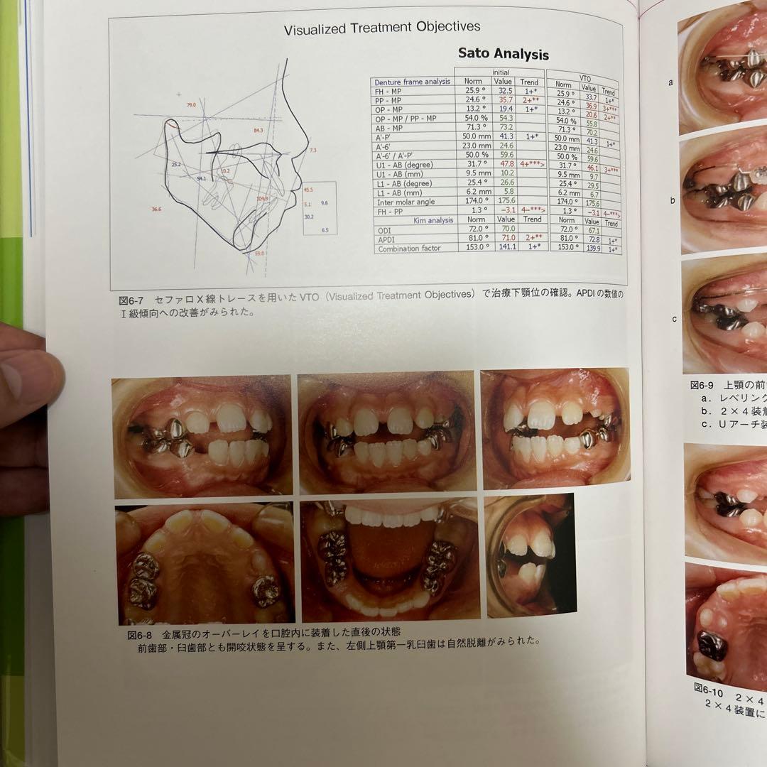 成長・発達期における不正咬合の早期治療