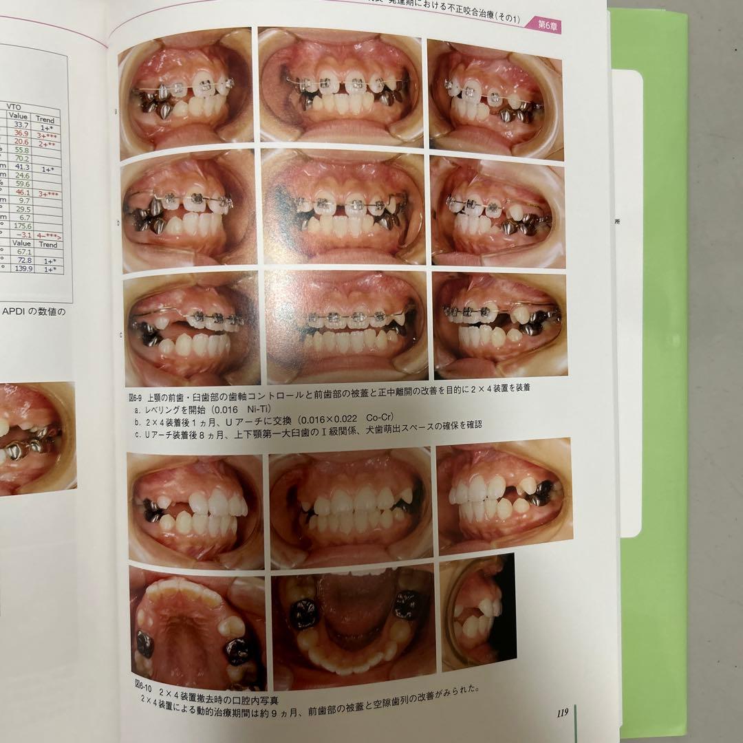 成長・発達期における不正咬合の早期治療
