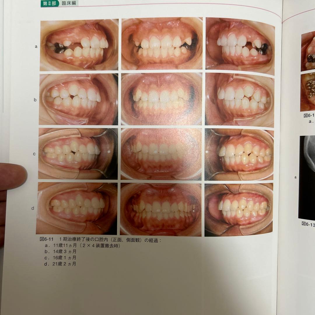成長・発達期における不正咬合の早期治療