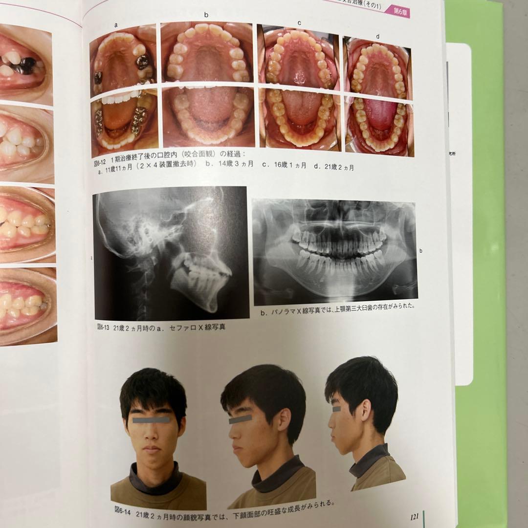 成長・発達期における不正咬合の早期治療